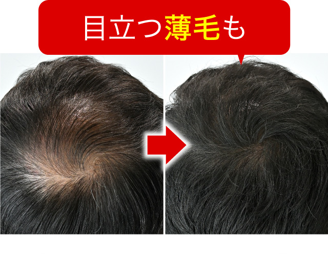 目立つ薄毛も